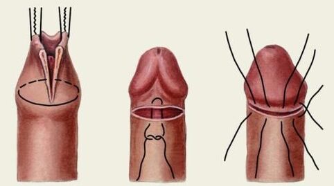 Come viene eseguita la chirurgia plastica del pene